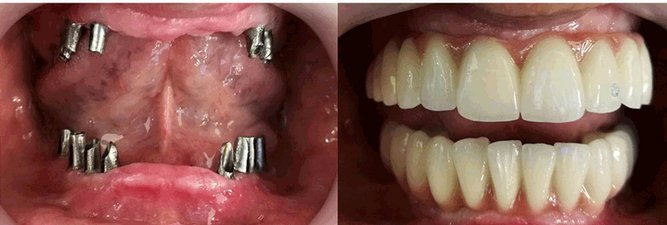 Implant-01.jpg