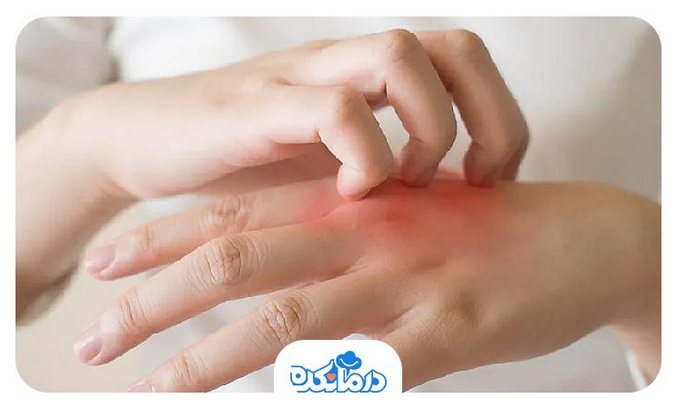 تاول پوستی دیشیدروتیک که روی پوست دست ایجاد شده است