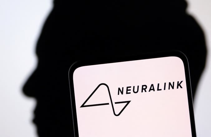 بازگشت قدرت تکلم بیمار ALS با تراشه Neuralink