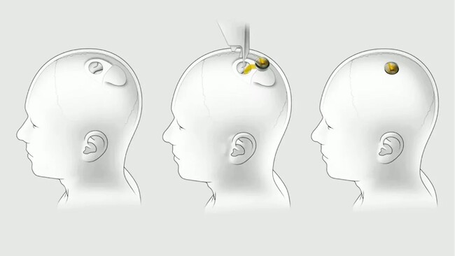 neuralink-installation.jpg